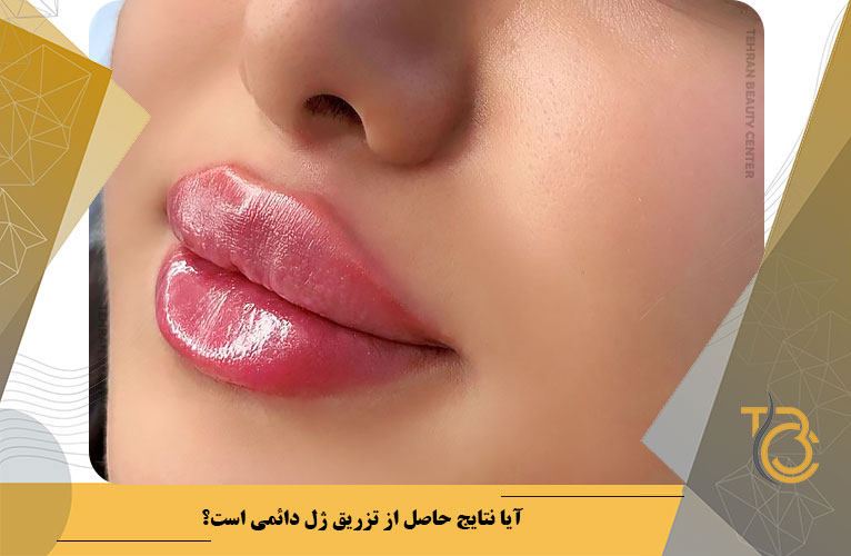 آیا نتایج حاصل از تزریق ژل دائمی است؟