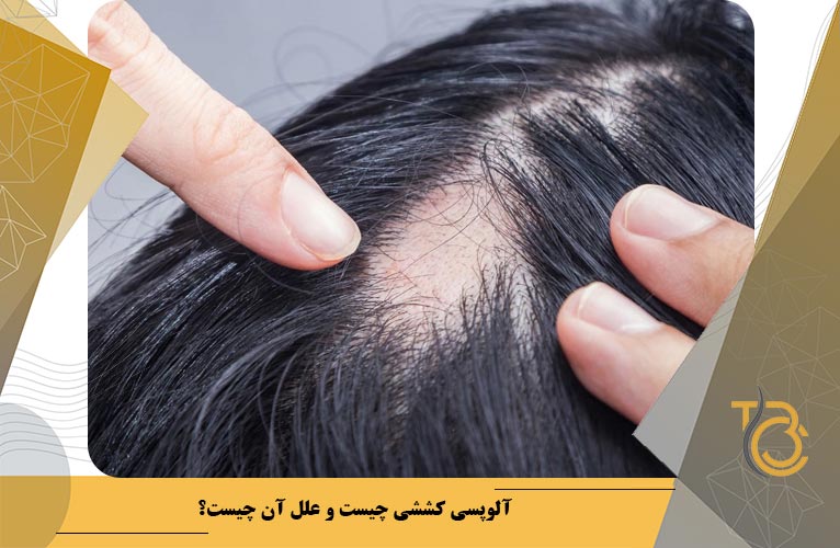 آلوپسی کششی یکی از دلایل ریزش مو