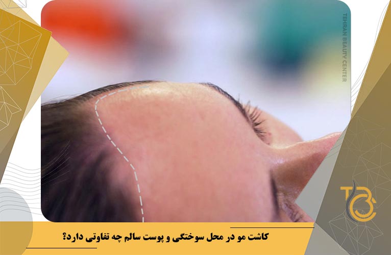 کاشت مو در محل سوختگی و پوست سالم چه تفاوتی دارد؟