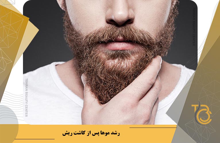 رشد موهای پس از کاشت ریش