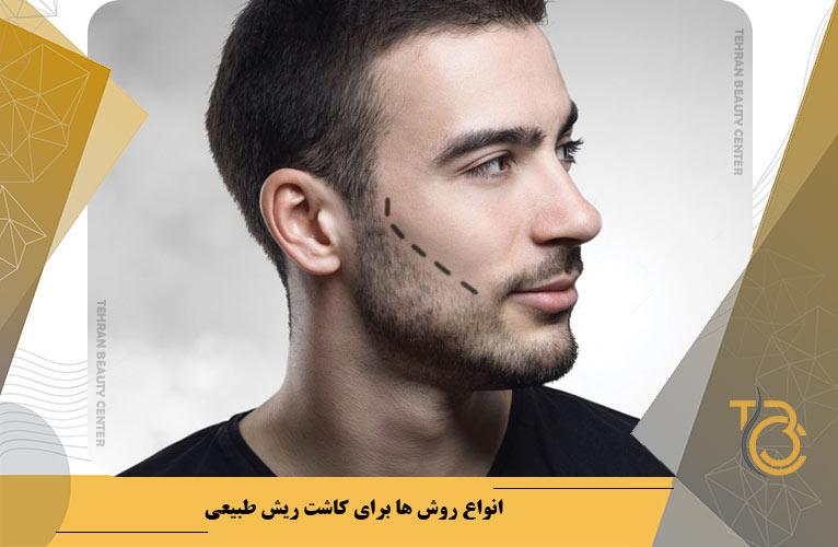 انواع روش ها برای کاشت ریش طبیعی