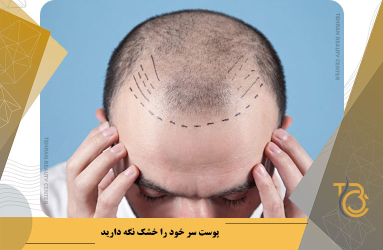 پوست سر خود را خشک نگه دارید