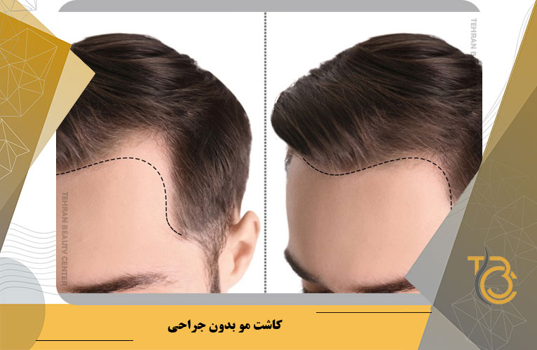 کاشت مو بدون جراحی