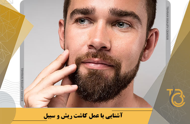 آشنایی با عمل کاشت ریش و سبیل