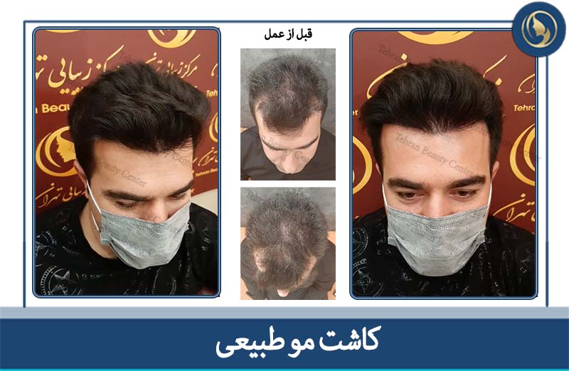عکس کاشت مو