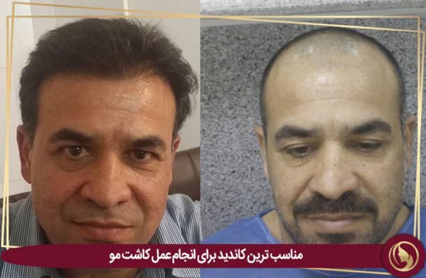 کاشت مو