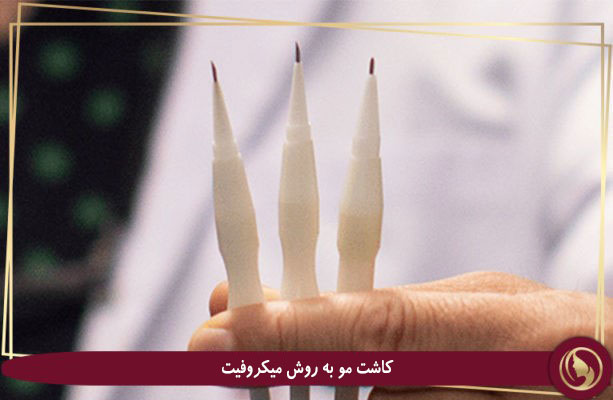 کاشت مو