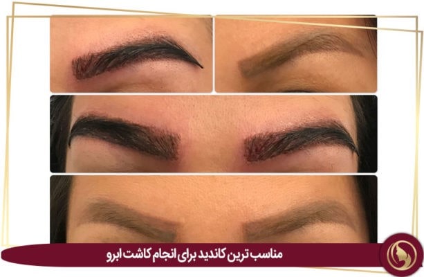 پیوند ابرو