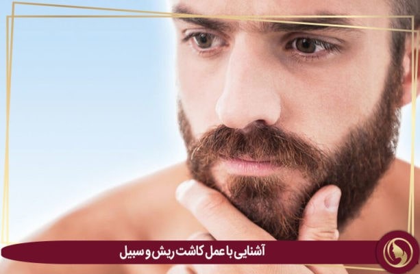 کاشت ریش