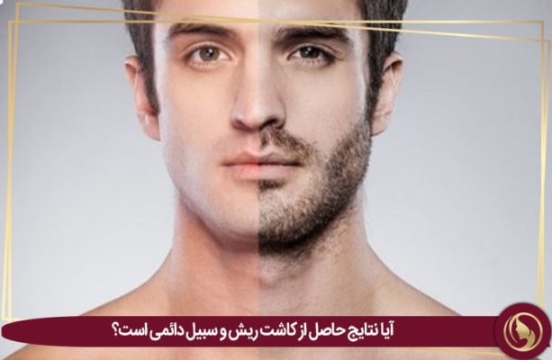 کاشت ریش مردانه