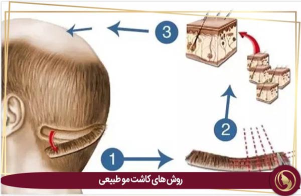 کاشت موی طبیعی