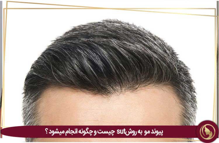 پیوند مو به روش SUT چیست و چگونه انجام می شود؟