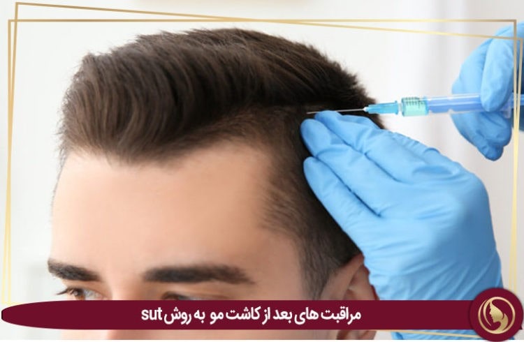 بعد از کاشت مو به روش SUT چه مراقبت هایی نیاز است؟