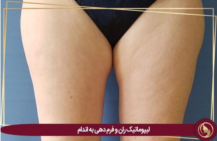 لیپوماتیک ران
