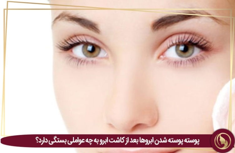 کاشت ابرو