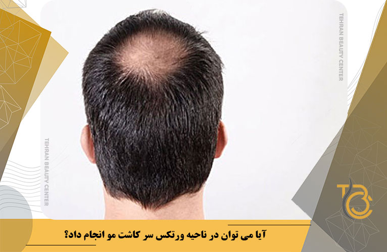 آیا می توان در ناحیه ورتکس سر کاشت مو انجام داد؟