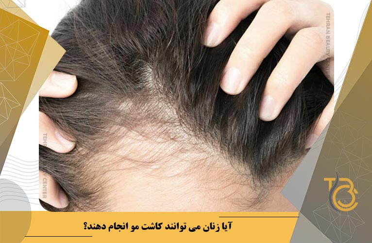 آیا زنان می توانند کاشت مو انجام دهند؟