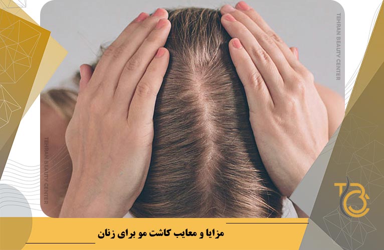 مزایا و معایب کاشت مو برای زنان