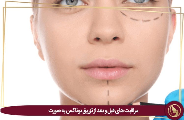 بوتاکس صورت