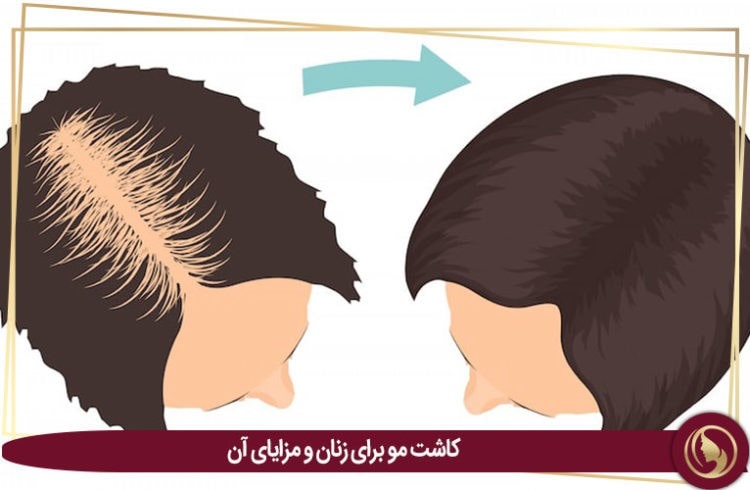 کاشت مو