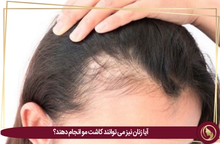 کاشت مو بانوان