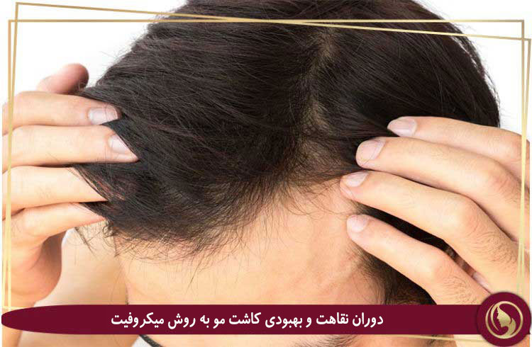 کاشت مو DHI