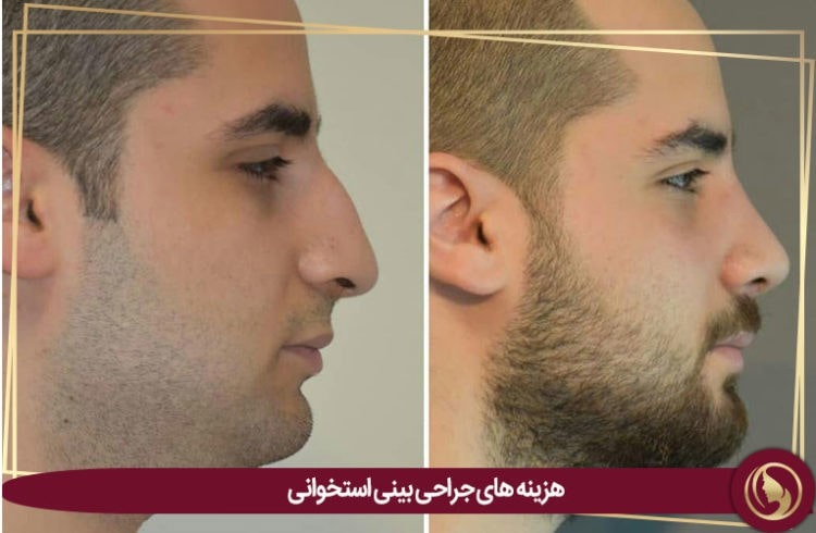 هزینه جراحی بینی