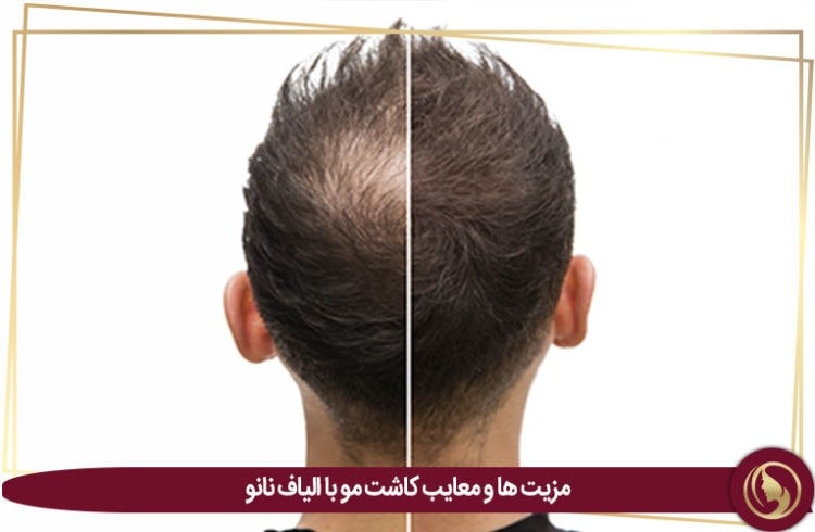 مزایا و معایب کاشت مو با الیاف نانو