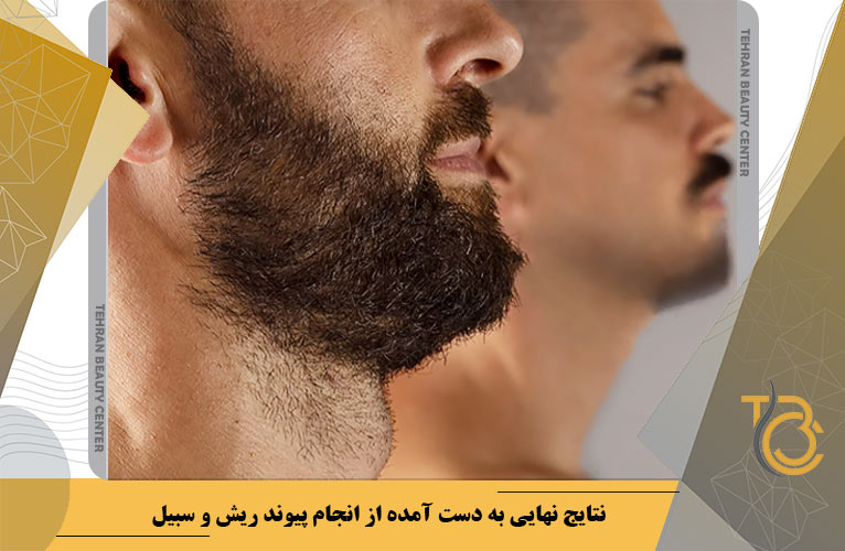 نتایج نهایی به دست آمده از انجام پیوند ریش و سبیل