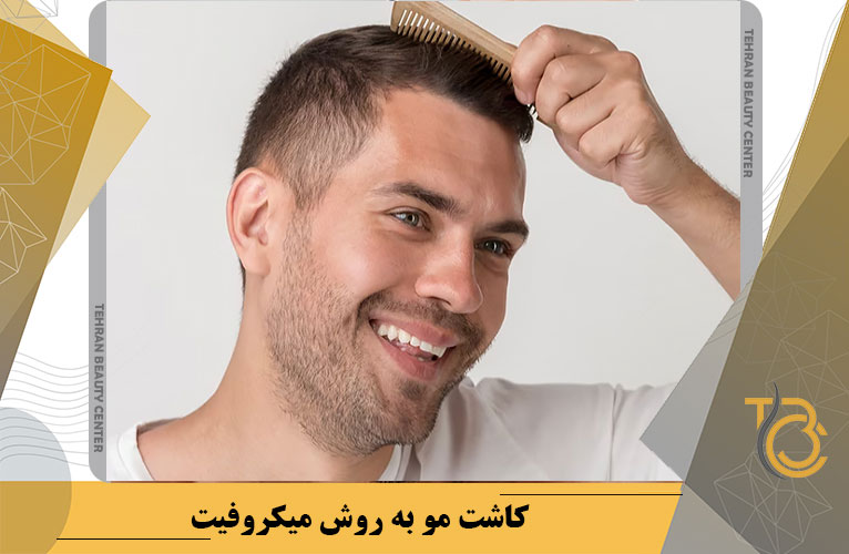 کاشت مو به روش میکروفیت