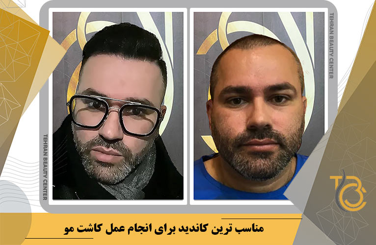 مناسبت ترین کاندید برای انجام عمل کاشت مو