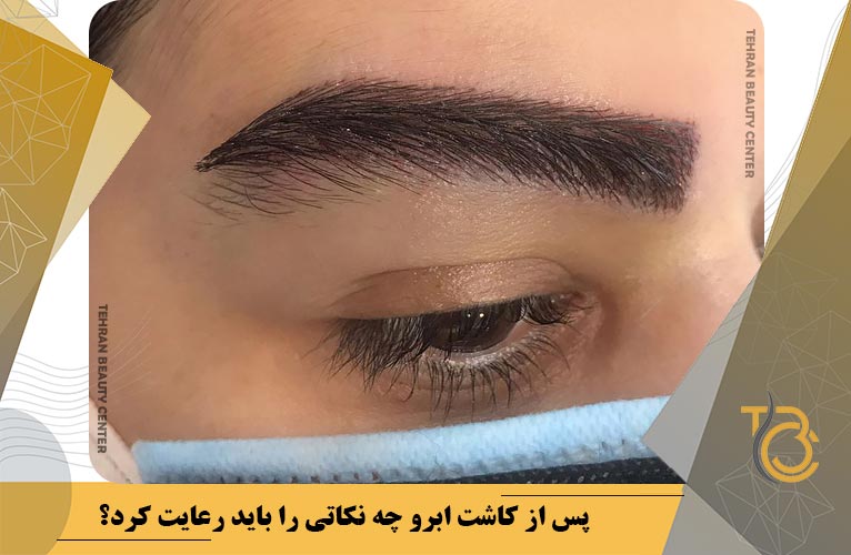 نکات بعد از کاشت ابرو