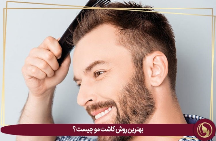 بهترین روش کاشت مو