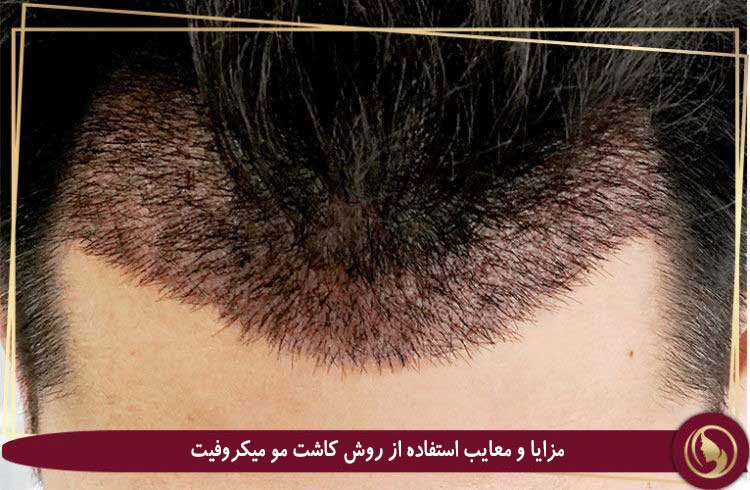 مزایا و معایب کاشت مو