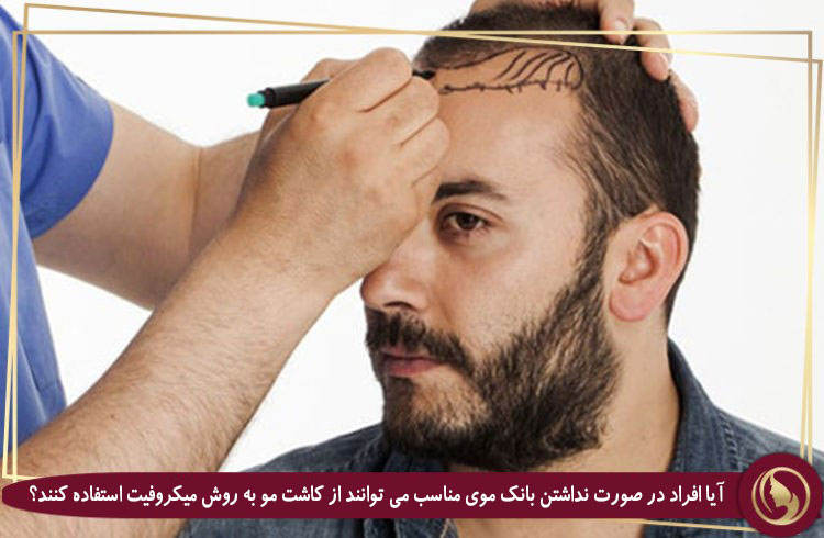 کاشت مو DHI