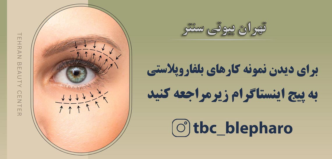 بلفاروپلاستی