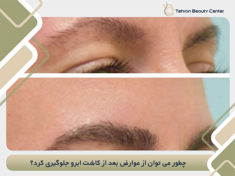 چطور می توان از عوارض بعد از کاشت ابرو جلوگیری کرد؟