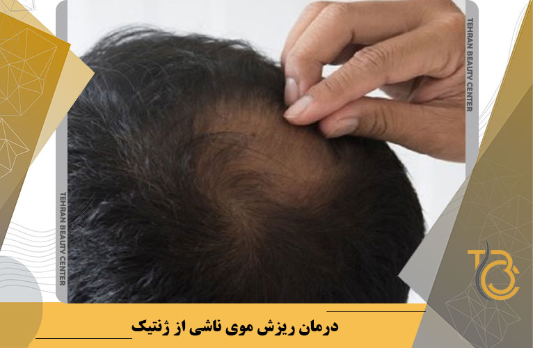 درمان ریزش موی ناشی از ژنتیک