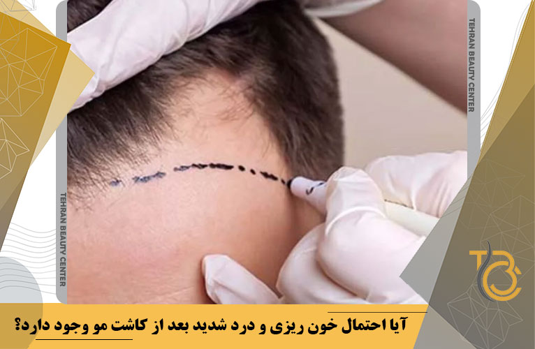 آیا احتمال خون ریزی و درد شدید بعد از کاشت مو وجود دارد؟