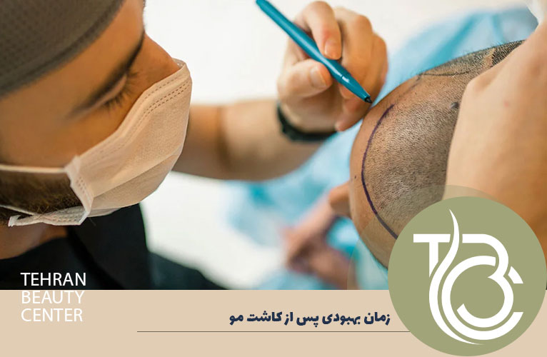 زمان بهبودی پس از کاشت مو