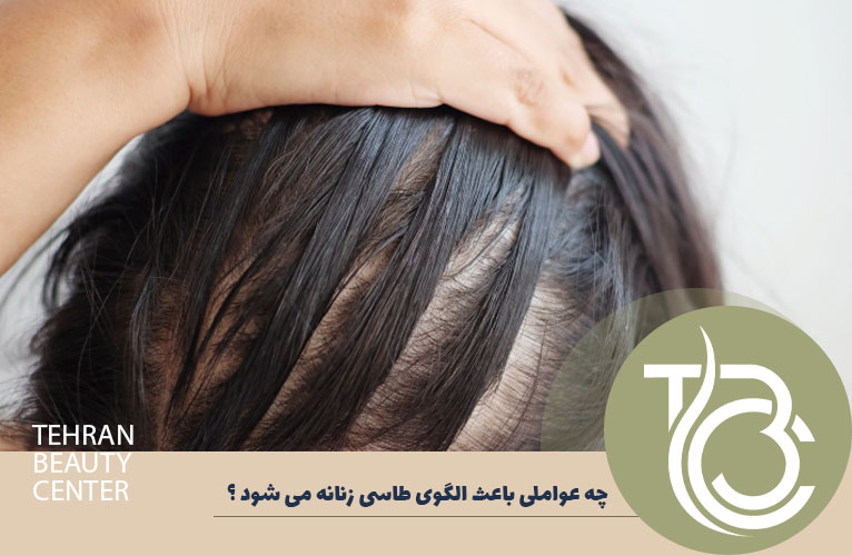 چه عواملی باعث الگوی طاسی زنانه می شود؟