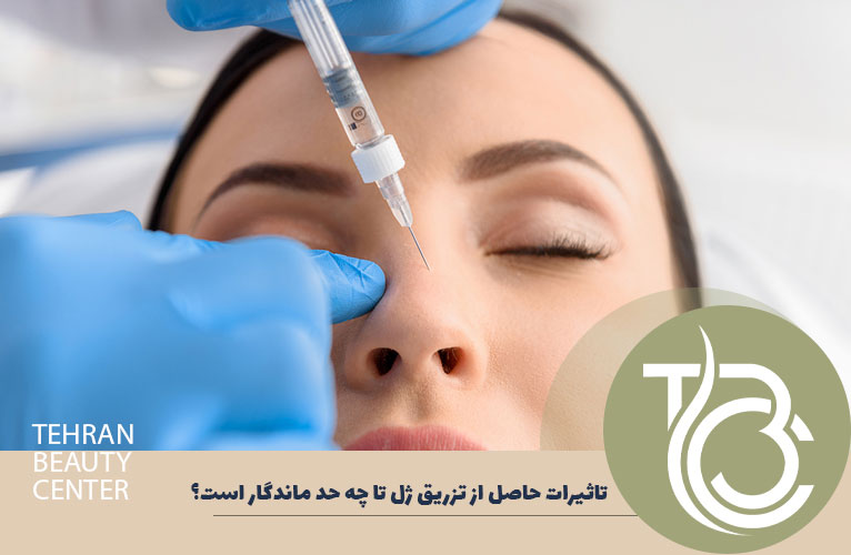ماندگاری تزریق ژل