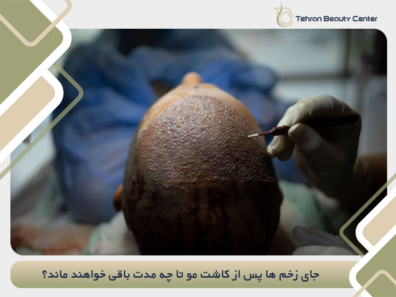 جای زخم ها پس از کاشت مو تا چه مدت باقی خواهند ماند؟