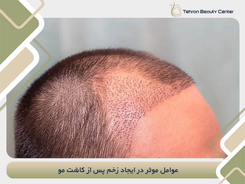 عوامل موثر در ایجاد زخم پس از کاشت مو
