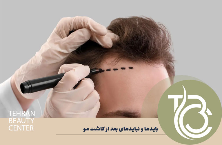 باید ها و نباید های بعد از کاشت مو