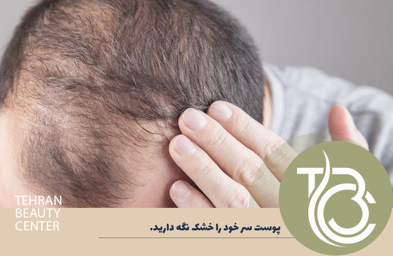 بایدهای بعد از کاشت مو