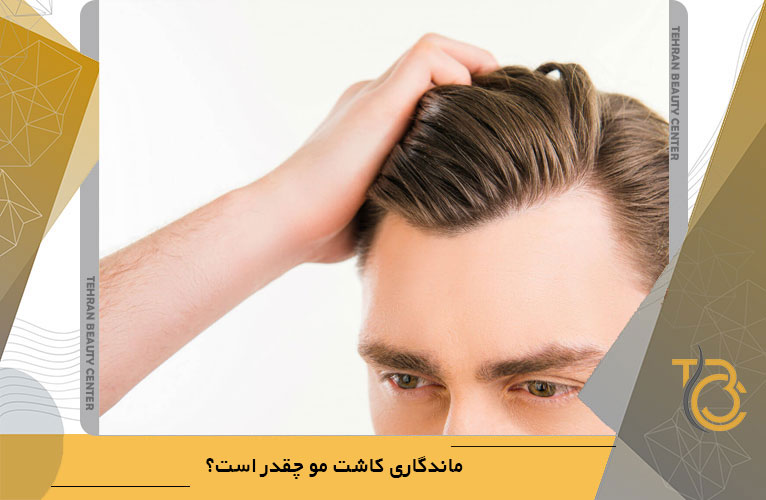 ماندگاری کاشت مو چقدر است؟
