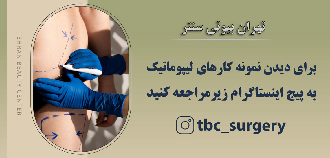 لیپوماتیک