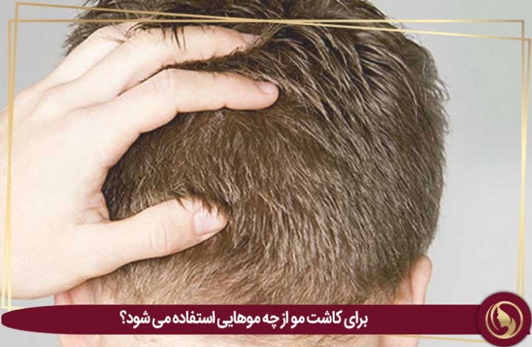 برای کاشت مو از چه موهایی استفاده می شود؟