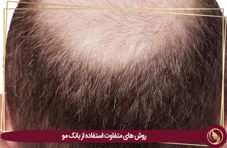 کاشت مو با بانک موی فرد